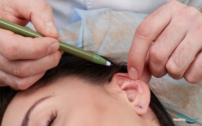 Otoplasty and All-on-6